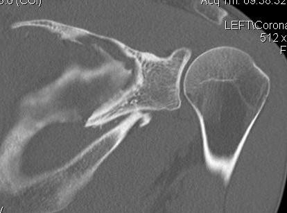 Glenoid Neck Fracture CT